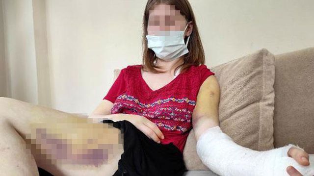 Erkek arkadaşının beyzbol sopasıyla dövdüğü kadın, korkunç geceyi anlattı Erkek arkadaşının beyzbol sopasıyla dövdüğü kadın, korkunç geceyi anlattı