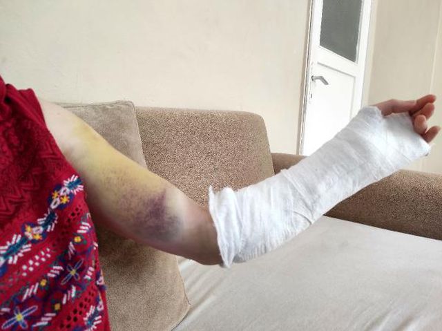 Erkek arkadaşının beyzbol sopasıyla dövdüğü kadın, korkunç geceyi anlattı Erkek arkadaşının beyzbol sopasıyla dövdüğü kadın, korkunç geceyi anlattı