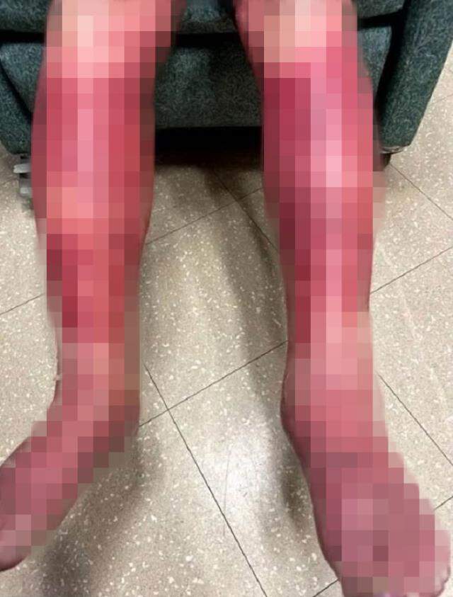 Korona aşısı olan yaşlı adamın tüm vücudu şişlik ve kızarıklıklarla kaplandı