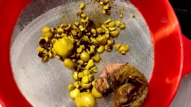 56 yaşındaki kadının safra kesesinde 278 taş çıkarıldı 56 yaşındaki kadının safra kesesinde 278 taş çıkarıldı