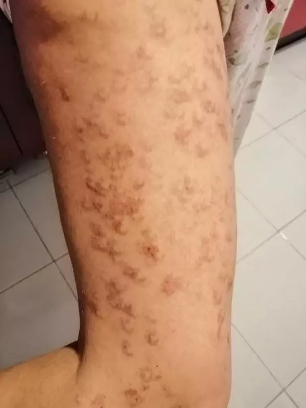 İZMİR-LAZER EPİLASYONDA BACAKLARINDA 'YANIK OLUŞTUĞU' İDDİASIYLA ŞİKAYETÇİ OLDU İZMİR-LAZER EPİLASYONDA BACAKLARINDA 'YANIK OLUŞTUĞU' İDDİASIYLA ŞİKAYETÇİ OLDU