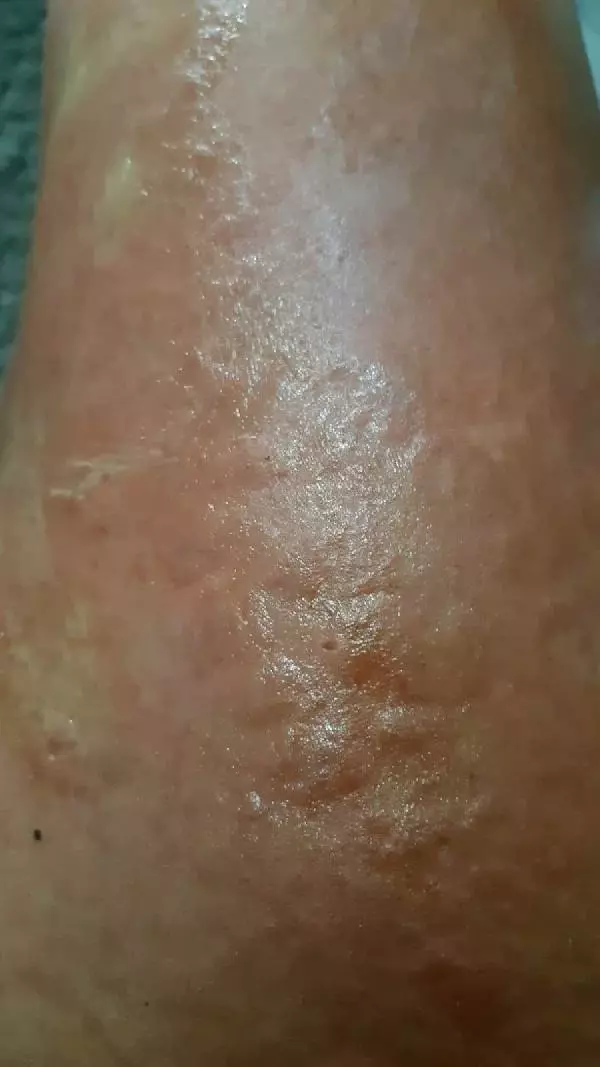 İZMİR-LAZER EPİLASYONDA BACAKLARINDA 'YANIK OLUŞTUĞU' İDDİASIYLA ŞİKAYETÇİ OLDU İZMİR-LAZER EPİLASYONDA BACAKLARINDA 'YANIK OLUŞTUĞU' İDDİASIYLA ŞİKAYETÇİ OLDU