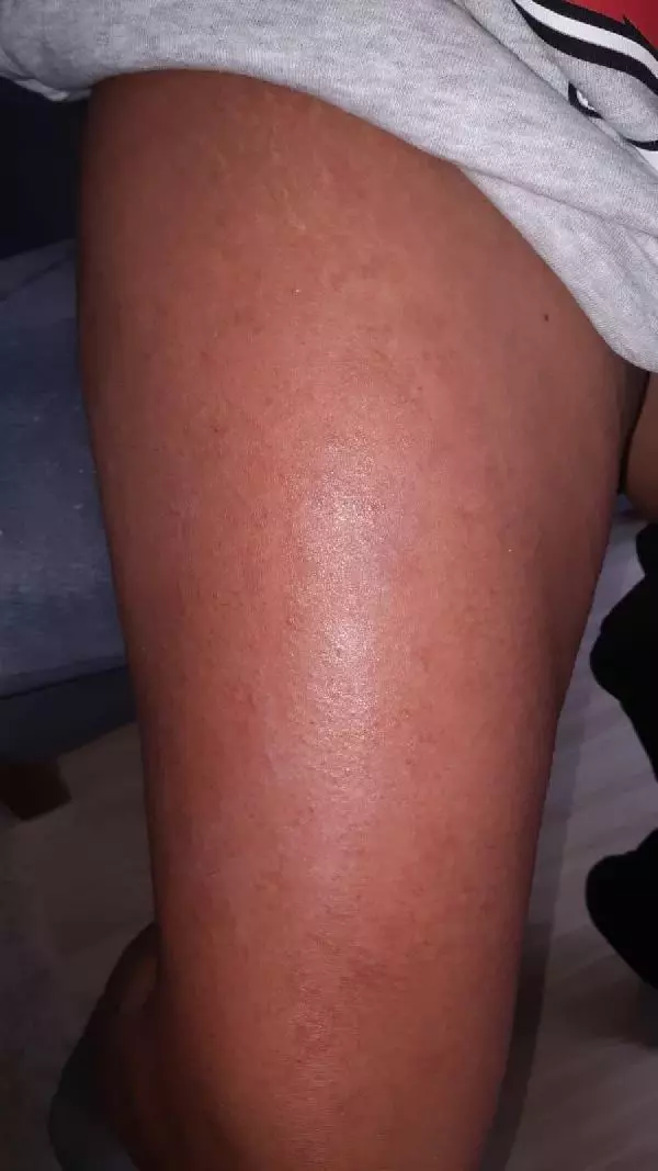 İZMİR-LAZER EPİLASYONDA BACAKLARINDA 'YANIK OLUŞTUĞU' İDDİASIYLA ŞİKAYETÇİ OLDU İZMİR-LAZER EPİLASYONDA BACAKLARINDA 'YANIK OLUŞTUĞU' İDDİASIYLA ŞİKAYETÇİ OLDU