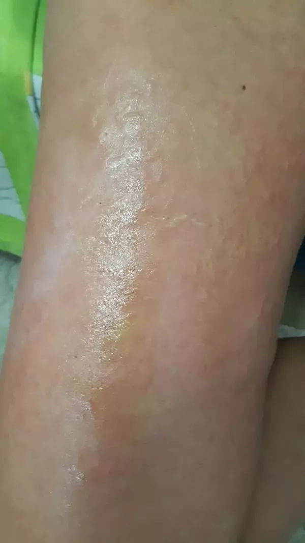 İZMİR-LAZER EPİLASYONDA BACAKLARINDA 'YANIK OLUŞTUĞU' İDDİASIYLA ŞİKAYETÇİ OLDU İZMİR-LAZER EPİLASYONDA BACAKLARINDA 'YANIK OLUŞTUĞU' İDDİASIYLA ŞİKAYETÇİ OLDU
