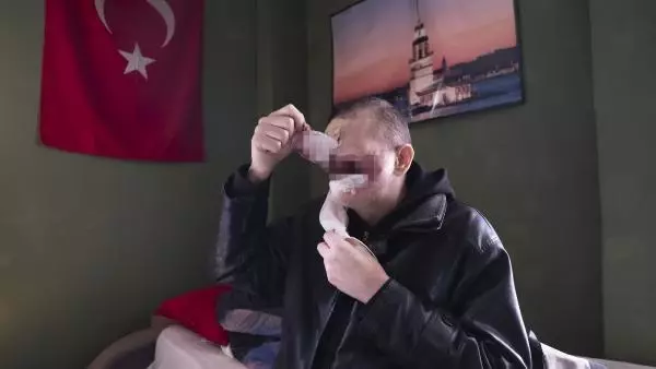 Cilt kanserinden yüzünü kaybeden baba: Kızımı öpmeyi çok özledim Cilt kanserinden yüzünü kaybeden baba: Kızımı öpmeyi çok özledim