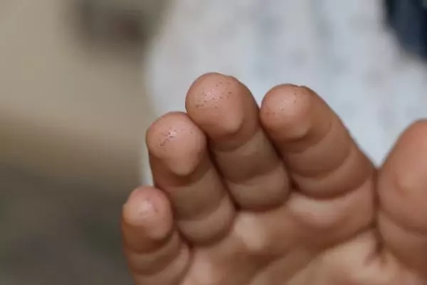 Son dakika haberleri! ADANA ŞEKER ÖLÇÜMÜ İÇİN SÜREKLİ PARMAKLARI DELİNEN ÇOCUKLAR SENSÖR DESTEĞİ İSTİYOR Son dakika haberleri! ADANA ŞEKER ÖLÇÜMÜ İÇİN SÜREKLİ PARMAKLARI DELİNEN ÇOCUKLAR SENSÖR DESTEĞİ İSTİYOR