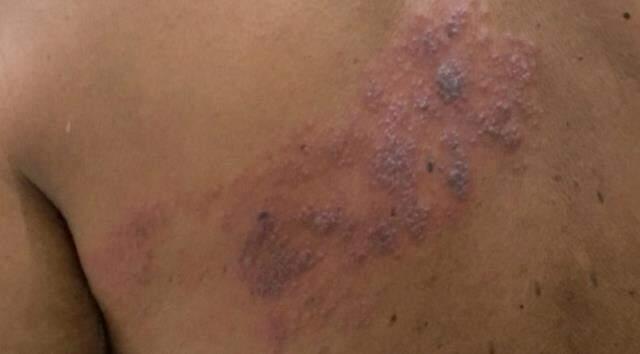 Zona hastalığı nedir? Zona hastalığı belirtileri nelerdir?