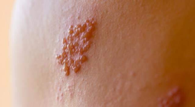 Zona hastalığı nedir? Zona hastalığı belirtileri nelerdir?