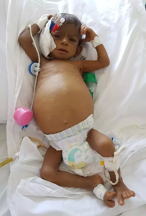 TAMER BEBEK İÇİN SINIR ÖTESİ KARACİĞER OPERASYONU TAMER BEBEK İÇİN SINIR ÖTESİ KARACİĞER OPERASYONU