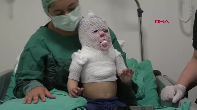 ESKİŞEHİR Kaynar suyla haşlanan Beril bebek Yanık Merkezi'nde tedavi altında ESKİŞEHİR Kaynar suyla haşlanan Beril bebek Yanık Merkezi'nde tedavi altında