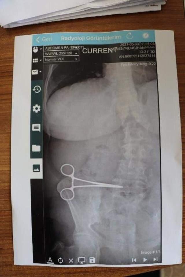 İyileşeceğim diye girdiği ameliyattan hasta çıktı! 2 ay, karnında unutulan makasla yaşadı