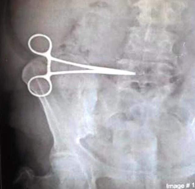 İyileşeceğim diye girdiği ameliyattan hasta çıktı! 2 ay, karnında unutulan makasla yaşadı