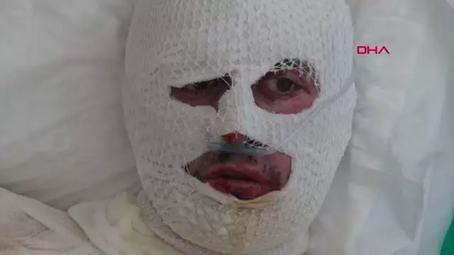 ÜZERİNE YILDIRIM DÜŞEN ÇOBAN AĞIR YARALANDI ÜZERİNE YILDIRIM DÜŞEN ÇOBAN AĞIR YARALANDI