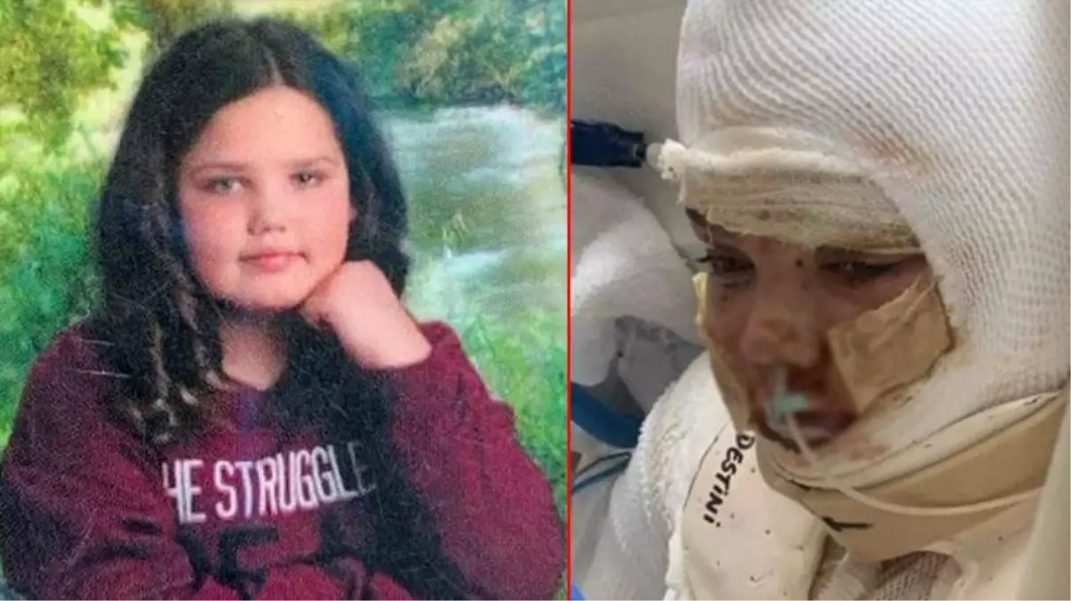 Korkunç olay! Tiktok'taki alkolle yazı yazma akımına katılan 13 yaşındaki kız çocuğu, alevler içerisinde kaldı