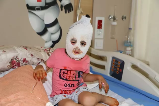 Sıcak suyla oynarken yanan minik Ayfer tedaviye alındı Sıcak suyla oynarken yanan minik Ayfer tedaviye alındı