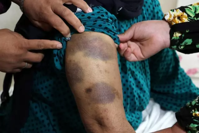 Düşüncesi bile korkuttu! Yaşlı kadından özel hastanede işkence iddiası! Hastane yönetimi iddiaları kabul etmedi Düşüncesi bile korkuttu! Yaşlı kadından özel hastanede işkence iddiası! Hastane yönetimi iddiaları kabul etmedi