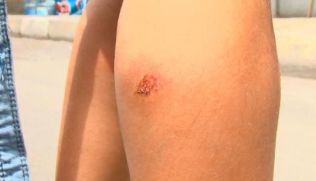 Korona bitmeden İstanbul'un göbeğinde yeni kabus! Sivrisineklerin soktuğu çocuklarda yaralar oluşmaya başladı