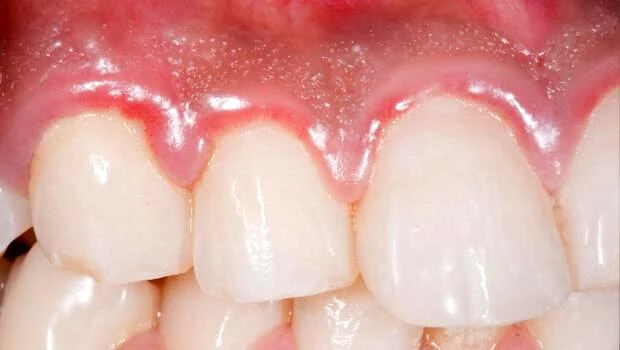 Diş iltihabına ne iyi gelir ve nasıl geçer? Diş iltihabı neden olur