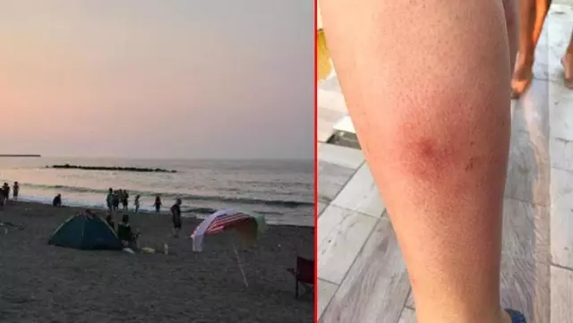 Karasu'da denize giren kaşınarak çıktı, 32 kişi soluğu hastanede aldı Karasu'da denize giren kaşınarak çıktı, 32 kişi soluğu hastanede aldı