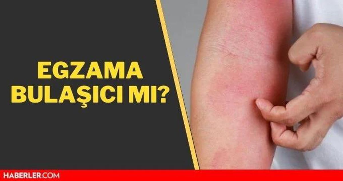 Egzama bulaşıcı mı? Egzama nedir, belirtileri nelerdir?