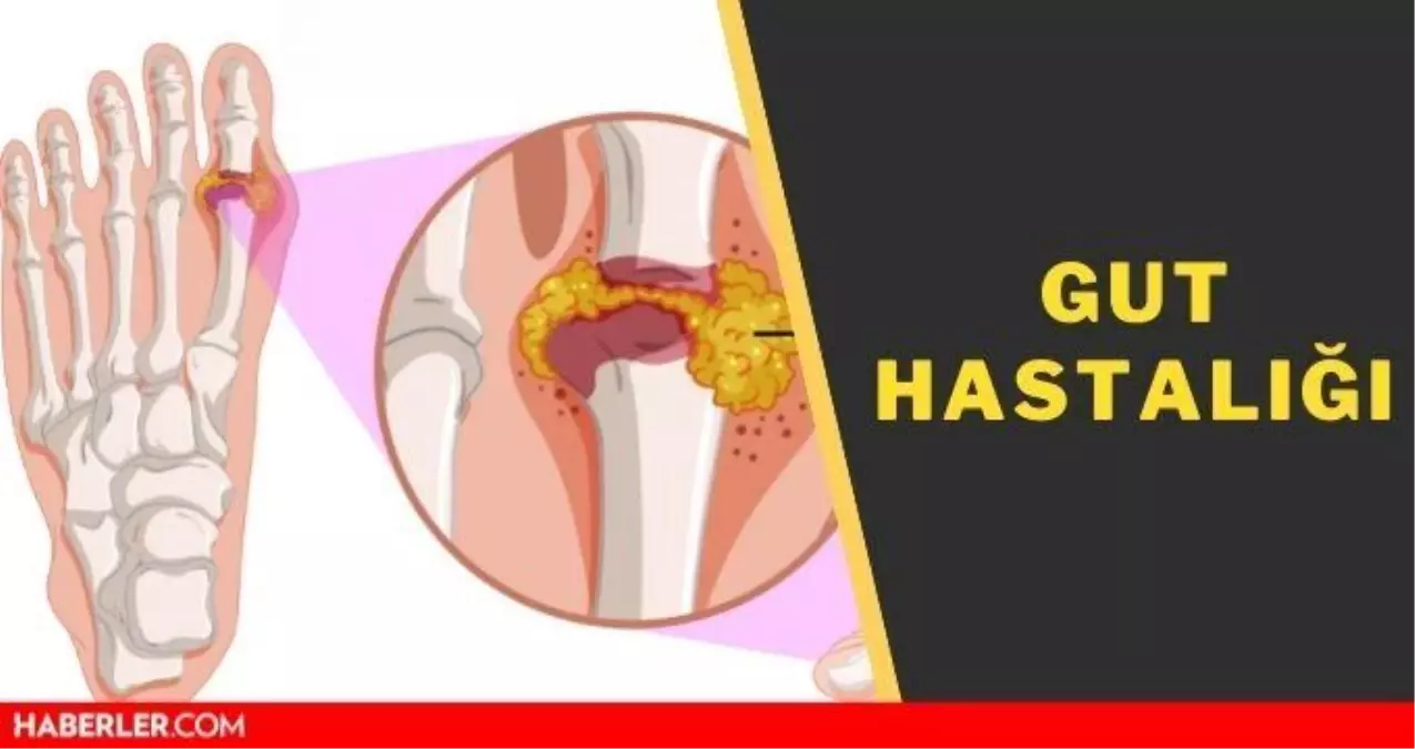 Gut hastalığı nedir, belirtileri neler? Gut hastalığı neden olur, ne iyi gelir? Gut hastalığı ağrısına ne iyi gelir?