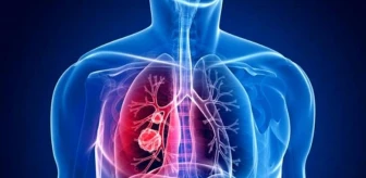 Akciğer kanseri belirtileri nelerdir? Akciğer kanseri ilk evre belirtileri! Akciğer kanseri 4 evre ölüm belirtileri nedir?