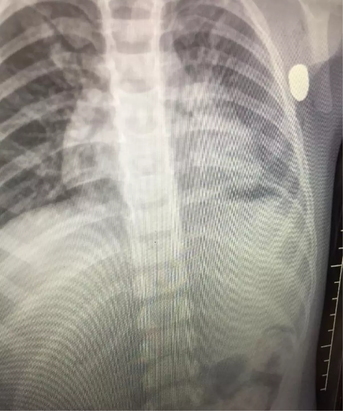 Salıncakta göğsüne 'yorgun mermi' isabet eden Emir, ağır yaralandı