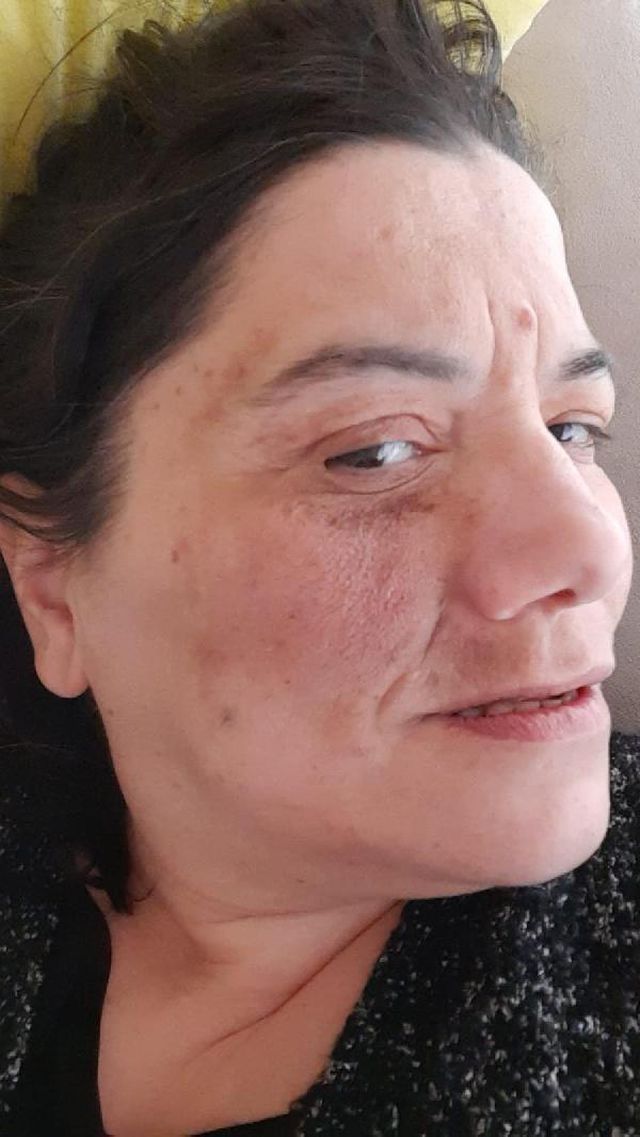 damak tedavisinde yuz felci olan yeliz hayati 2 14377978 o