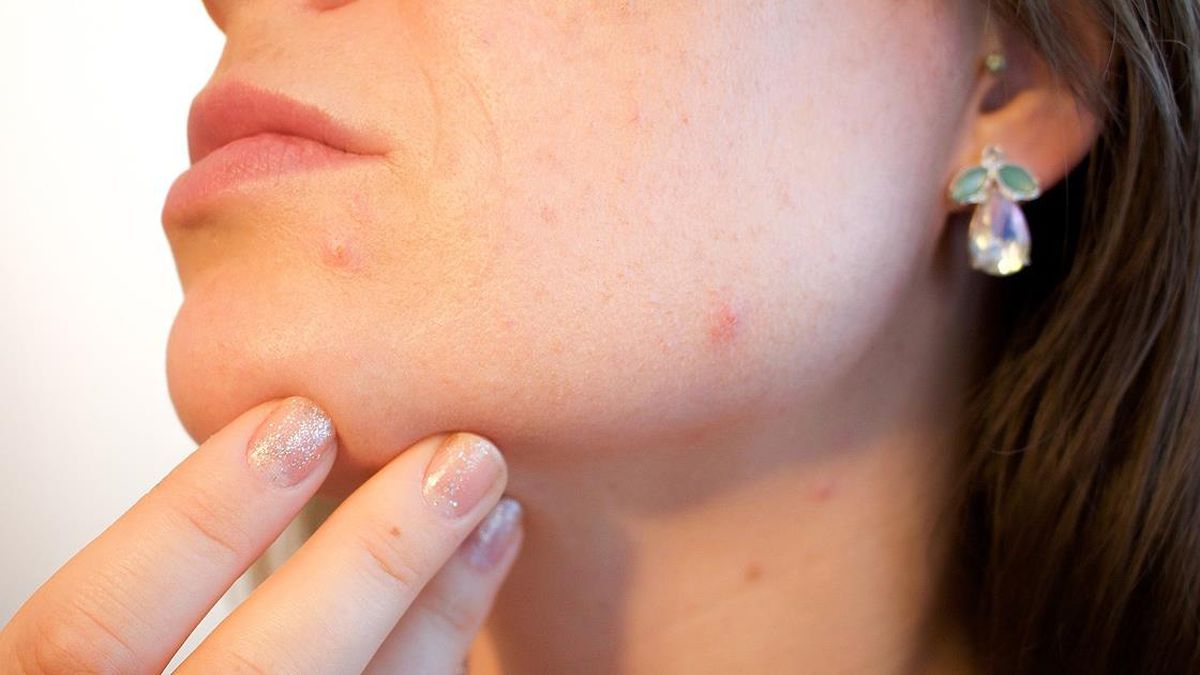 Lupus hastalığı nedir, ne demek? Lupus hastalığı belirtileri nelerdir? Lupus hastalığı neden olur, tedavisi var mı, nasıl yapılır?
