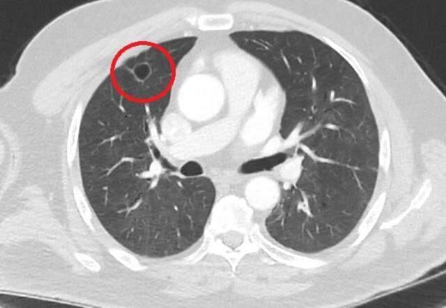 Dünya tıp literatüründe bir ilk! Koronavirüsün akciğer kanserini taklit ettiği tespit edildi