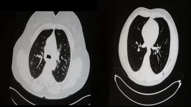 Aşılı ve aşısız olarak koronaya yakalanan 2 gencin akciğer tomografisi korkunç gerçeği gözler önüne serdi