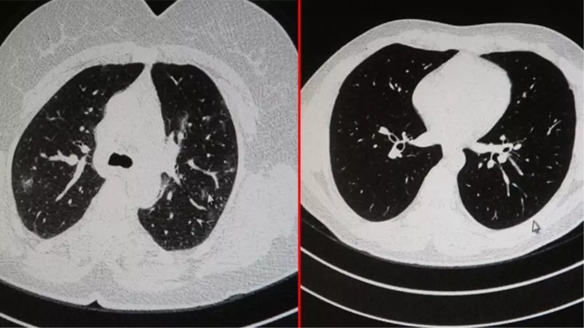 Aşılı ve aşısız olarak koronaya yakalanan 2 gencin akciğer tomografisinde dikkat çeken fark