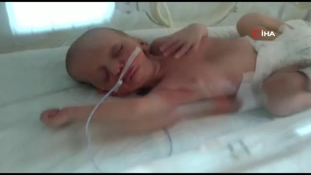 MHP ve AK Parti, doğuştan dudakları yapışık olan Umut bebek için seferber oldu