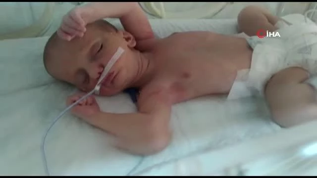 MHP ve AK Parti, doğuştan dudakları yapışık olan Umut bebek için seferber oldu
