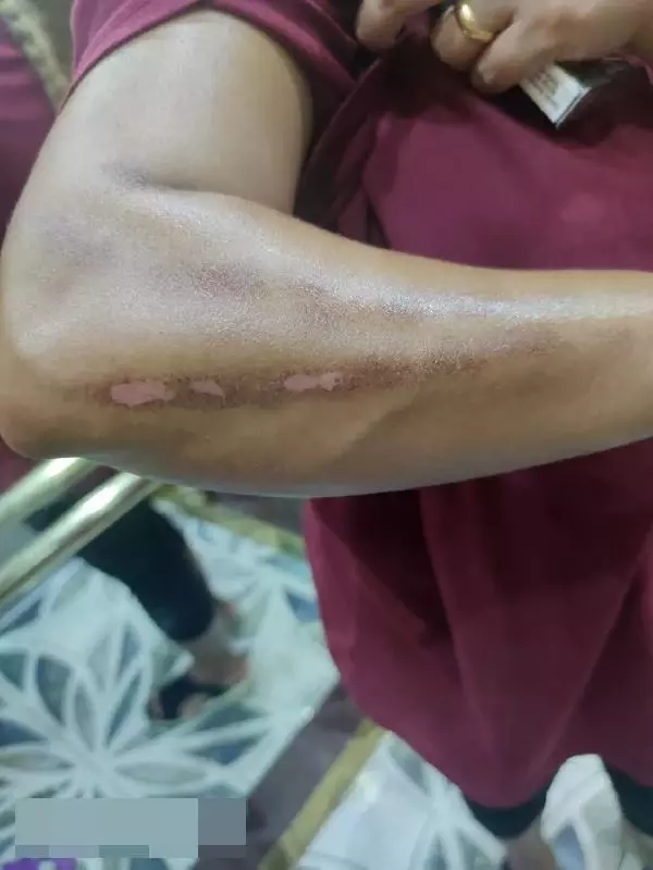 GÜZELLİK MERKEZİNDE LAZER İŞLEMİ YAPTIRDI, KOLLARI VE BACAĞI YANDI