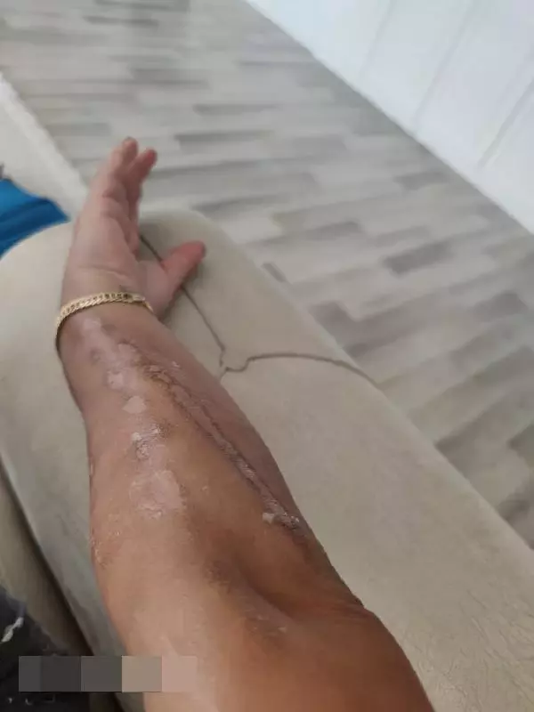 GÜZELLİK MERKEZİNDE LAZER İŞLEMİ YAPTIRDI, KOLLARI VE BACAĞI YANDI