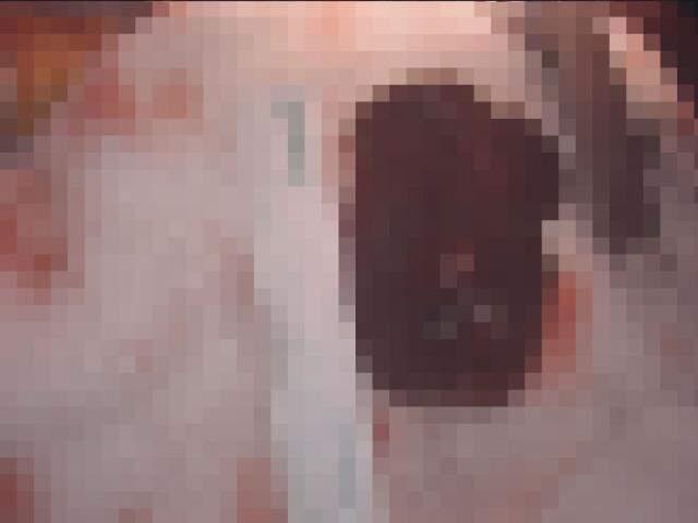 Korona şüphesiyle hastaneye kaldırılan kadının kalbinden çıkan tümör, doktorları bile şaşkına uğrattı Korona şüphesiyle hastaneye kaldırılan kadının kalbinden çıkan tümör, doktorları bile şaşkına uğrattı