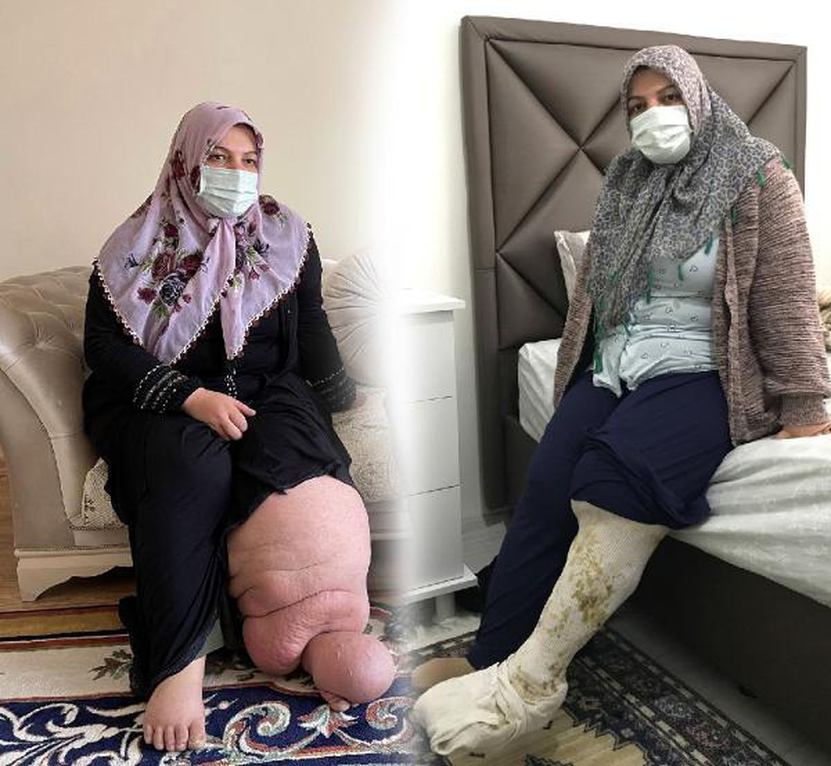 21 YILLIK FİL HASTASI, AYAKKABI VE ÇORAP HAYALİNE KAVUŞUYOR