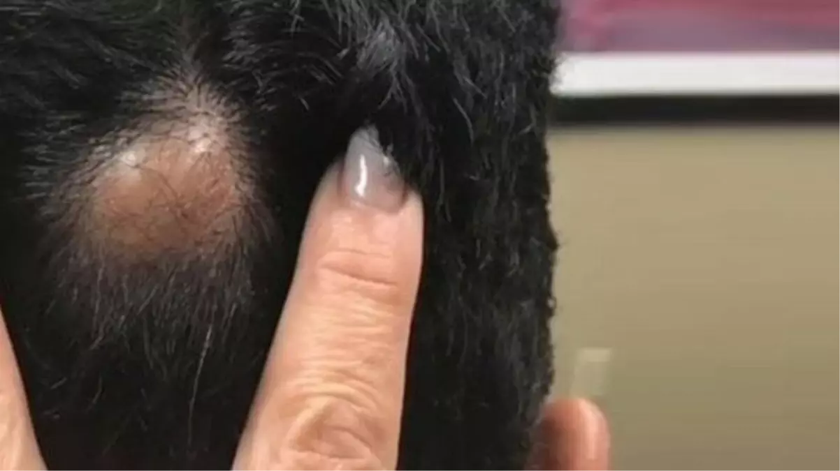 Adamın kafasındaki derinin altından çıkana, ameliyatı yapan doktor bile inanmadı