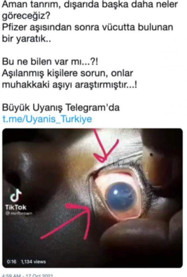 Koronavirüs aşısı olan bir kişinin gözünde solucan oluştuğu iddiası