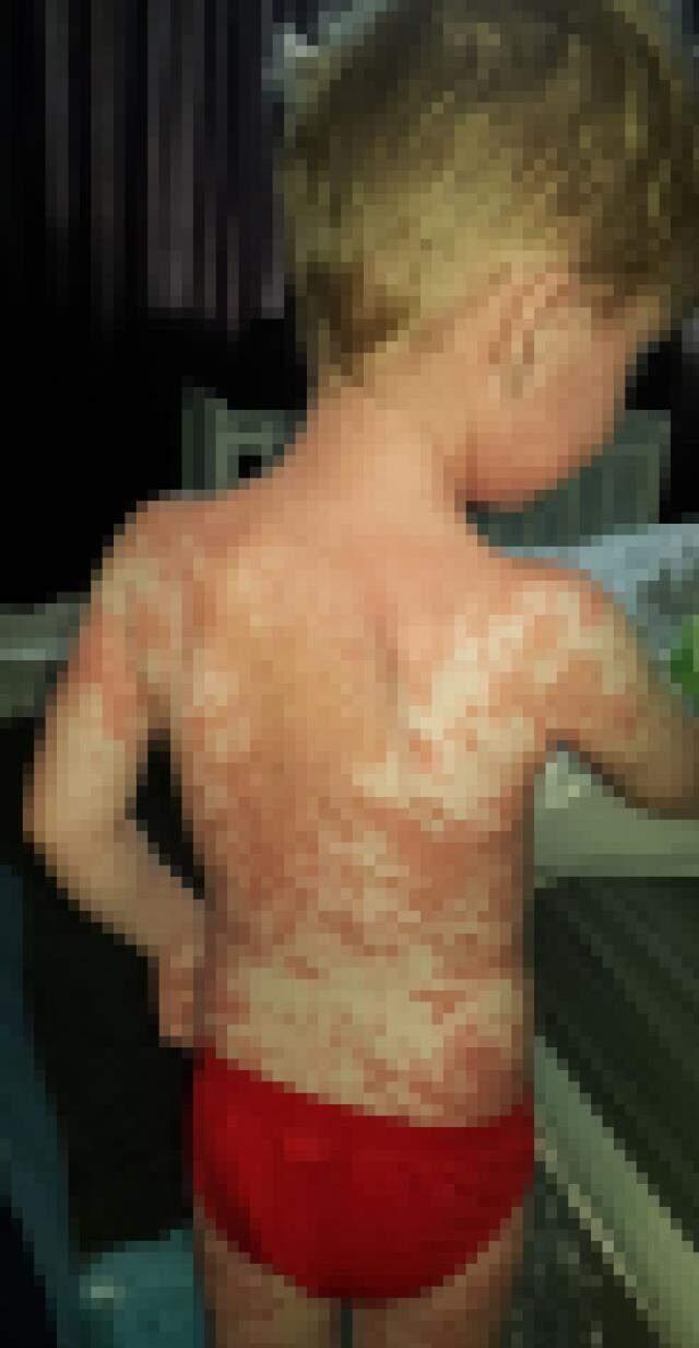 Yılan gibi her gün deri değiştiren çocuğun fotoğrafları görenleri korkuttu