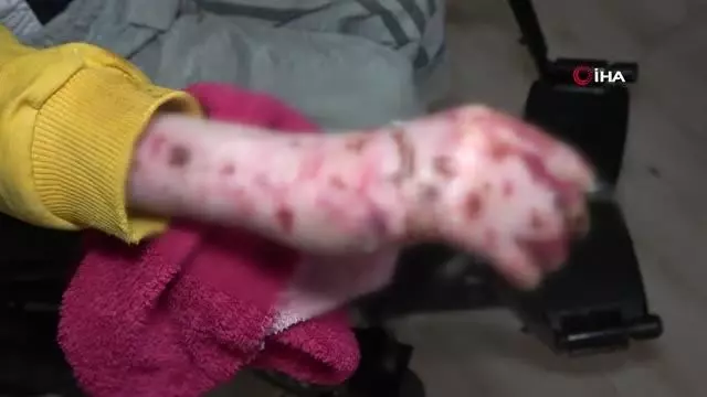 Kelebek hastası Seyfettin parmaklarına kavuştu