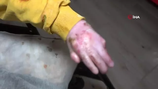 Kelebek hastası Seyfettin parmaklarına kavuştu