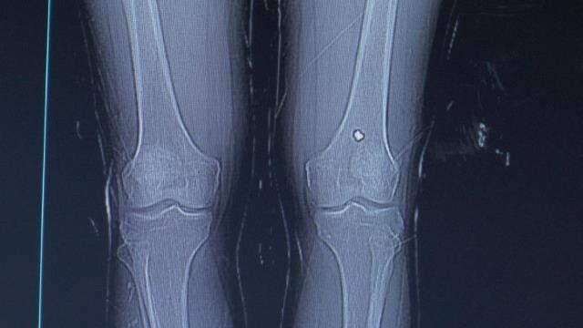 Tüfekle vurulan şahıs ağrıları artınca doktora gitti, hayatının şokunu yaşadı Tüfekle vurulan şahıs ağrıları artınca doktora gitti, hayatının şokunu yaşadı