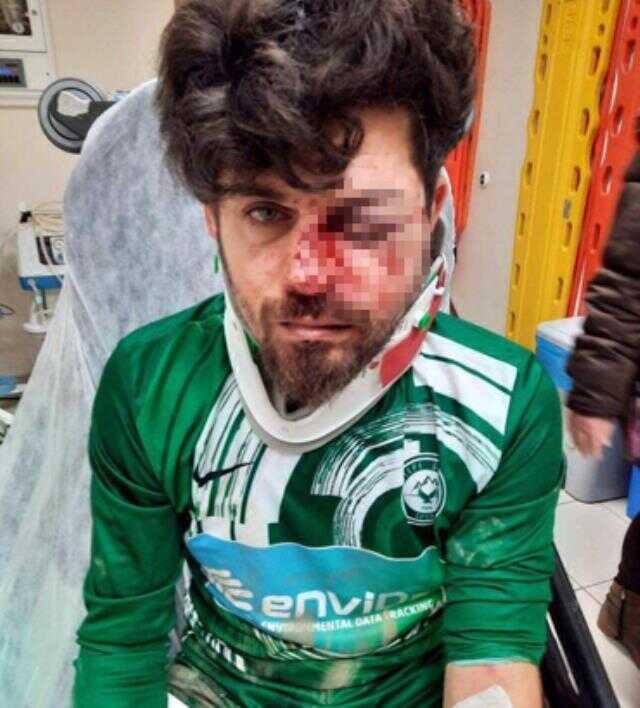 Kırmızı kart gören futbolcu, yerde yatan rakibinin yüzüne tekme atıp yaraladı Kırmızı kart gören futbolcu, yerde yatan rakibinin yüzüne tekme atıp yaraladı