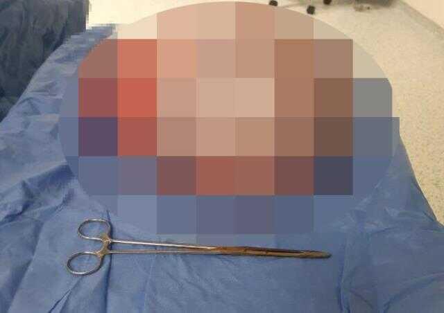 Karnından çıkana doktorlar bile inanamadı! 64 kilo girdiği ameliyattan 55 kilo çıktı