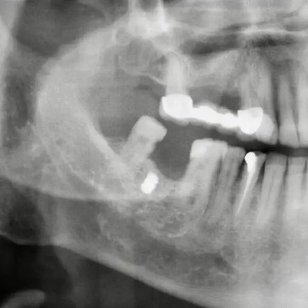 YANAĞINA SAPLANAN METAL PARÇASIYLA 15 YIL YAŞADI