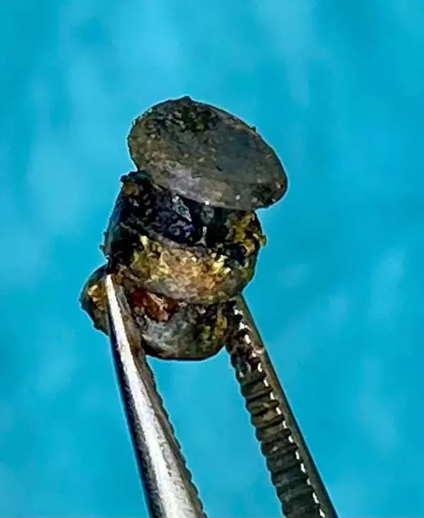 YANAĞINA SAPLANAN METAL PARÇASIYLA 15 YIL YAŞADI