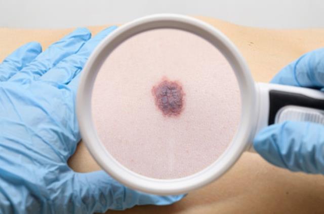 Sivilceye ne iyi gelir? Sivilce iyi gelen evde doğal yöntemler nelerdir? Yüz ve çene bölgesindeki sivilceye ne iyi gelir? Sivilceye ne iyi gelir? Sivilce iyi gelen evde doğal yöntemler nelerdir? Yüz ve çene bölgesindeki sivilceye ne iyi gelir?