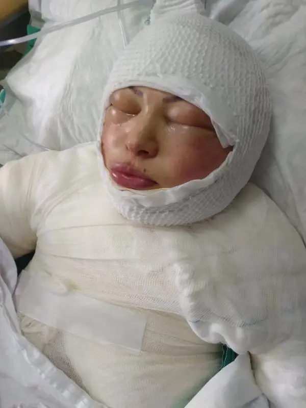 Eski eşi tarafından ateşe verilen talihsiz kadından kan donduran sözler: Söndürmeye çalışmadı, yanmamı izledi